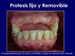 Protesis fija y Removible
El planeamiento por el cual es remitida es para un aumento del reborde.
 