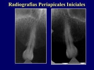 Radiografias Periapicales InicialesRadiografias Periapicales Iniciales
 