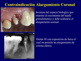 Contraindicación Alargamiento CoronalContraindicación Alargamiento Coronal
Invasion del espacio biologico que
muestra el crecimiento del tejido
granulomatoso y debe realizarse el
alargamiento coronal.
Diente 45 con exposicion de furca el
cual no permite un alargamiento de
corona clinica.
 
