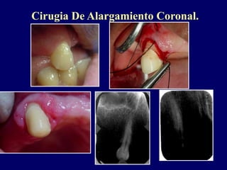 Cirugia De Alargamiento Coronal.
 