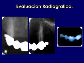 Evaluacion Radiografica.Evaluacion Radiografica.
 