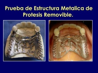 Prueba de Estructura Metalica dePrueba de Estructura Metalica de
Protesis Removible.Protesis Removible.
 