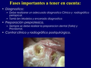 • Diagnostico:
– Debe realizarse un adecuado diagnostico Clínico y radiográfico
periapical.
– Tamb ien Modelos y encerado diagnostico
• Preparación preprotesica.
– Siempre se debe realizar la preparacion dental (Talla) y
Provisional.
• Control clínico y radiográfico postquirúrgico.
Fases importantes a tener en cuenta:
 