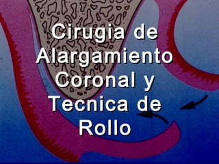 Cirugia deCirugia de
AlargamientoAlargamiento
Coronal yCoronal y
Tecnica deTecnica de
RolloRollo
 