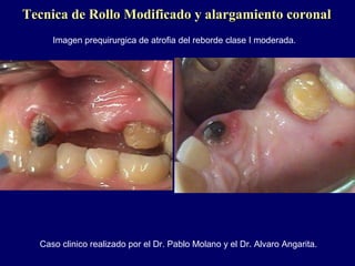 Tecnica de Rollo Modificado y alargamiento coronalTecnica de Rollo Modificado y alargamiento coronal
Caso clinico realizado por el Dr. Pablo Molano y el Dr. Alvaro Angarita.
Imagen prequirurgica de atrofia del reborde clase I moderada.
 