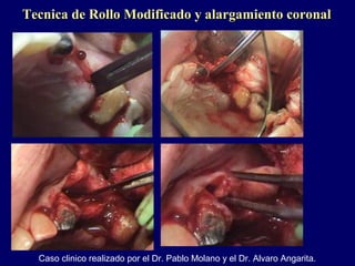 Caso clinico realizado por el Dr. Pablo Molano y el Dr. Alvaro Angarita.
Tecnica de Rollo Modificado y alargamiento coronalTecnica de Rollo Modificado y alargamiento coronal
 