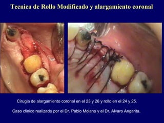 Cirugia de alargamiento coronal en el 23 y 26 y rollo en el 24 y 25.
Caso clinico realizado por el Dr. Pablo Molano y el Dr. Alvaro Angarita.
Tecnica de Rollo Modificado y alargamiento coronalTecnica de Rollo Modificado y alargamiento coronal
 