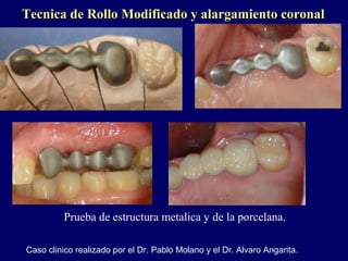 Tecnica de Rollo Modificado y alargamiento coronalTecnica de Rollo Modificado y alargamiento coronal
Prueba de estructura metalica y de la porcelana.
Caso clinico realizado por el Dr. Pablo Molano y el Dr. Alvaro Angarita.
 
