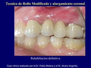 Tecnica de Rollo Modificado y alargamiento coronalTecnica de Rollo Modificado y alargamiento coronal
Rehabiliacion definitiva.
Caso clinico realizado por el Dr. Pablo Molano y el Dr. Alvaro Angarita.
 