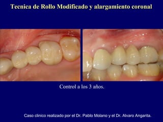 Tecnica de Rollo Modificado y alargamiento coronalTecnica de Rollo Modificado y alargamiento coronal
Control a los 3 años.
Caso clinico realizado por el Dr. Pablo Molano y el Dr. Alvaro Angarita.
 