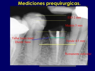 EIO 2 mm
Muñón 5 mm
Ferule 4.5 mm
Remanente radicular
Tallar hasta tener
Diente Sano
Mediciones prequirurgicas.Mediciones prequirurgicas.
 