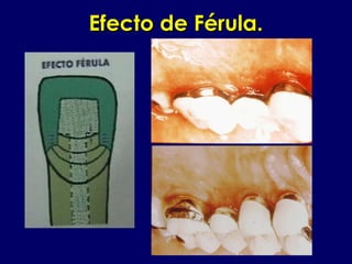 Efecto de Férula.Efecto de Férula.
 