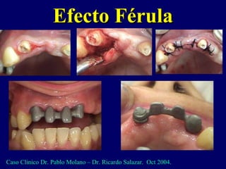 Efecto FérulaEfecto Férula
Caso Clinico Dr. Pablo Molano – Dr. Ricardo Salazar. Oct 2004.
 