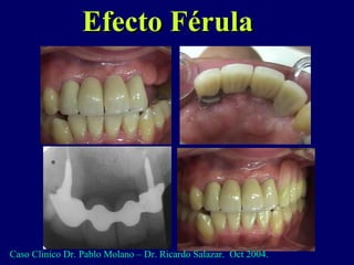 Efecto FérulaEfecto Férula
Caso Clinico Dr. Pablo Molano – Dr. Ricardo Salazar. Oct 2004.
 