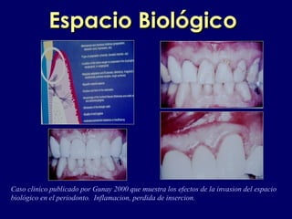 EspaciEspacioo BiológicoBiológico
Caso clinico publicado por Gunay 2000 que muestra los efectos de la invasion del espacio
biológico en el periodonto. Inflamacion, perdida de insercion.
 