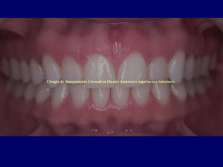 Cirugia de Alargamiento Coronal en Dientes Anteriores superiores e inferiores.
 