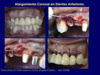 Caso clinico: Dr. Pablo Molano y la Dra. Magally Cuadros. . Mar 18 2004
Alargamiento Coronal en Dientes Anteriores.
 