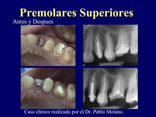 Antes y Despues
Premolares SuperioresPremolares Superiores
Caso clinico realizado por el Dr. Pablo Molano.
 
