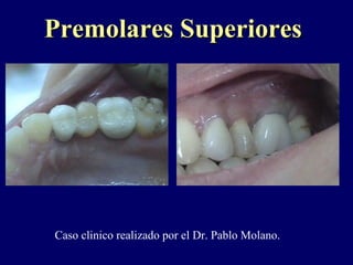 Premolares SuperioresPremolares Superiores
Caso clinico realizado por el Dr. Pablo Molano.
 
