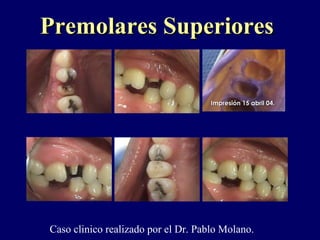 Impresión 15 abril 04.Impresión 15 abril 04.
Premolares SuperioresPremolares Superiores
Caso clinico realizado por el Dr. Pablo Molano.
 