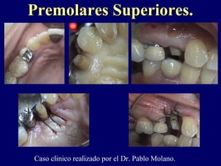 Premolares Superiores.Premolares Superiores.
Caso clinico realizado por el Dr. Pablo Molano.
 