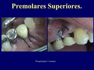 Premolares Superiores.Premolares Superiores.
Posquirurgico 1 semana
 