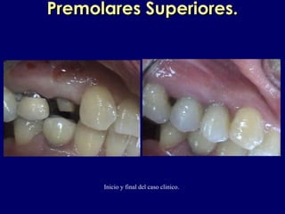 Premolares Superiores.Premolares Superiores.
Inicio y final del caso clinico.
 