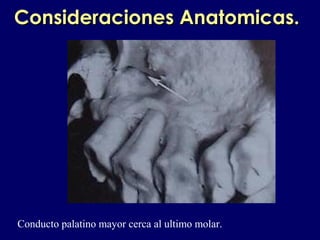 Consideraciones Anatomicas.Consideraciones Anatomicas.
Conducto palatino mayor cerca al ultimo molar.
 