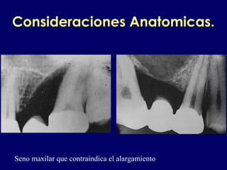Consideraciones Anatomicas.Consideraciones Anatomicas.
Seno maxilar que contraindica el alargamiento
 