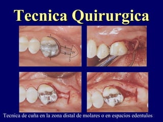 Tecnica QuirurgicaTecnica Quirurgica
Tecnica de cuña en la zona distal de molares o en espacios edentulos
 