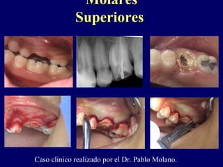 MolaresMolares
SuperioresSuperiores
Caso clinico realizado por el Dr. Pablo Molano.
 