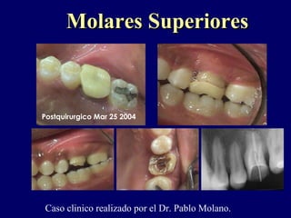 Postquirurgico Mar 25 2004
Molares SuperioresMolares Superiores
Caso clinico realizado por el Dr. Pablo Molano.
 