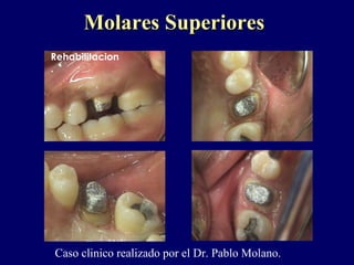 Rehabilitacion
.
Molares SuperioresMolares Superiores
Caso clinico realizado por el Dr. Pablo Molano.
 