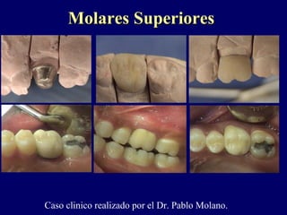 Molares SuperioresMolares Superiores
Caso clinico realizado por el Dr. Pablo Molano.
 