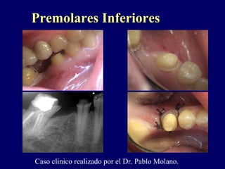 Premolares InferioresPremolares Inferiores
Caso clinico realizado por el Dr. Pablo Molano.
 