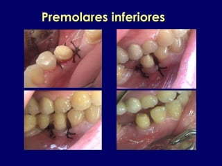 Premolares inferioresPremolares inferiores
 