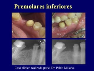 Premolares inferioresPremolares inferiores
Caso clinico realizado por el Dr. Pablo Molano.
 