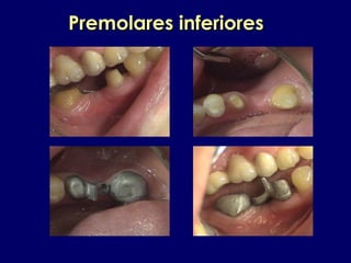 Premolares inferioresPremolares inferiores
 