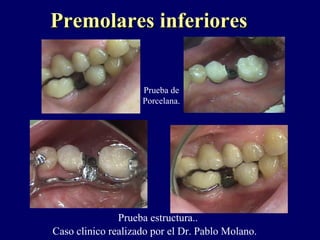 Prueba de
Porcelana.
Prueba estructura..
Premolares inferioresPremolares inferiores
Caso clinico realizado por el Dr. Pablo Molano.
 