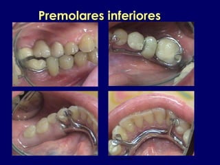 Eliana mayo 2004
Premolares inferioresPremolares inferiores
 