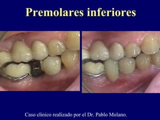 Premolares inferioresPremolares inferiores
Caso clinico realizado por el Dr. Pablo Molano.
 