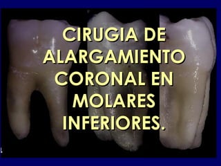 CIRUGIA DECIRUGIA DE
ALARGAMIENTOALARGAMIENTO
CORONAL ENCORONAL EN
MOLARESMOLARES
INFERIORES.INFERIORES.
 