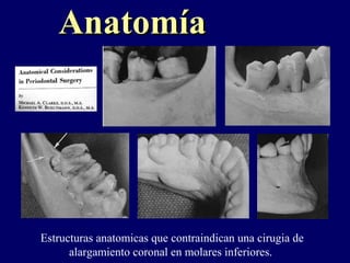 AnatomíaAnatomía
Estructuras anatomicas que contraindican una cirugia de
alargamiento coronal en molares inferiores.
 