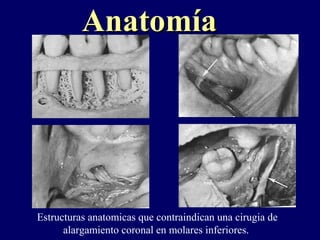 AnatomíaAnatomía
Estructuras anatomicas que contraindican una cirugia de
alargamiento coronal en molares inferiores.
 