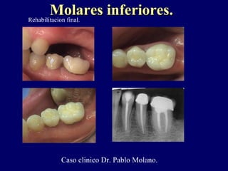 Molares inferiores.Molares inferiores.
Caso clinico Dr. Pablo Molano.
Rehabilitacion final.
 