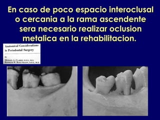 En caso de poco espacio interoclusalEn caso de poco espacio interoclusal
o cercania a la rama ascendenteo cercania a la rama ascendente
sera necesario realizar oclusionsera necesario realizar oclusion
metalica en la rehabilitacion.metalica en la rehabilitacion.
 