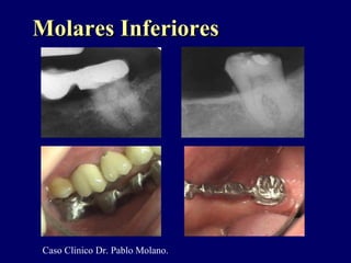 Molares InferioresMolares Inferiores
Caso Clinico Dr. Pablo Molano.
 