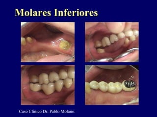 Molares InferioresMolares Inferiores
Caso Clinico Dr. Pablo Molano.
 
