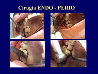 Cirugía ENDO - PERIOCirugía ENDO - PERIO
 