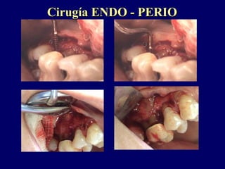 Cirugía ENDO - PERIOCirugía ENDO - PERIO
 